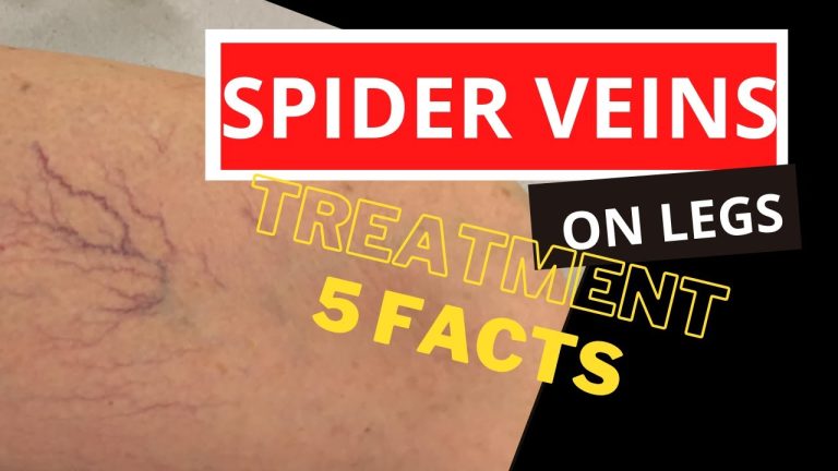 Can you massage spider veins away?