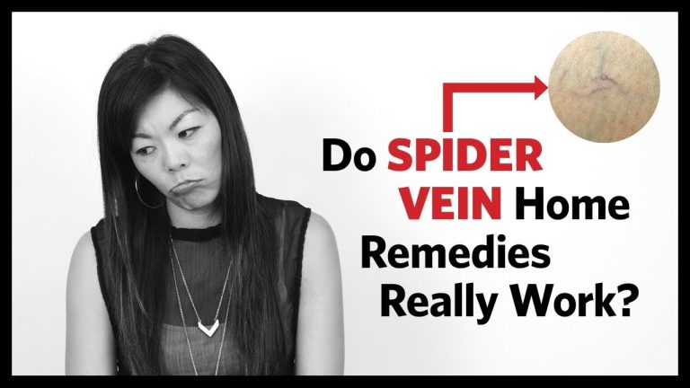 Does apple cider vinegar help get rid of spider veins?