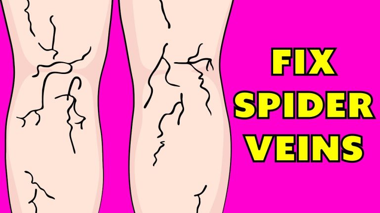 Does witch hazel get rid of spider veins?