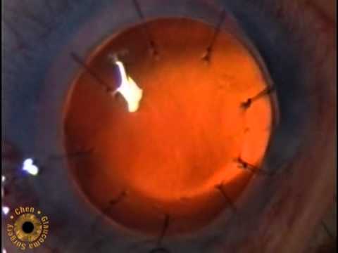 Ecp Ophthalmology