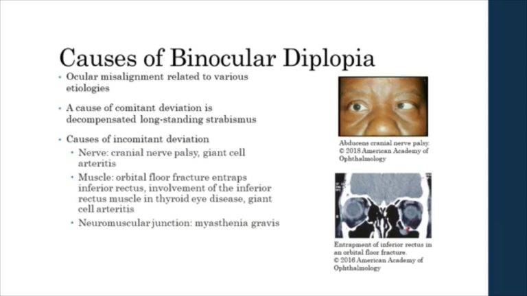 How common is diplopia?