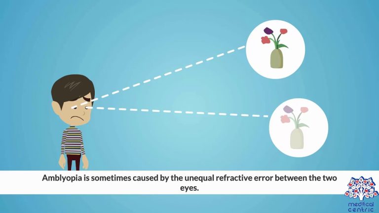 Is astigmatism a lazy eye?