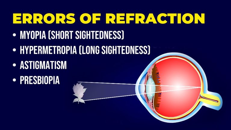 Is myopic astigmatism regular or irregular?