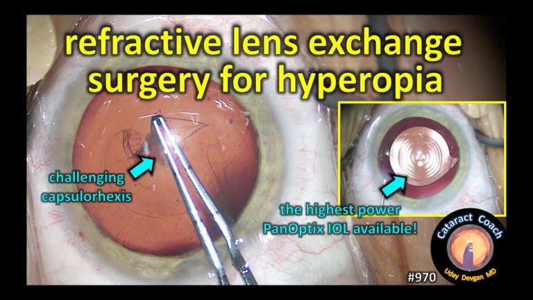 Is presbyopia same as Hypermetropia?