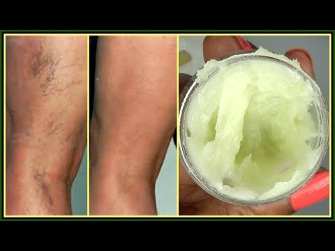 Is turmeric good for spider veins?