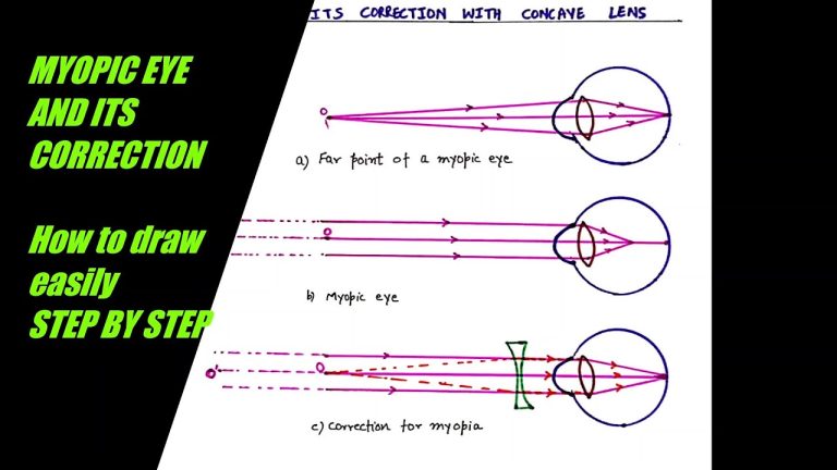 Nearsightedness Diagram