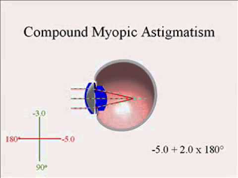 What are the two types of astigmatism?