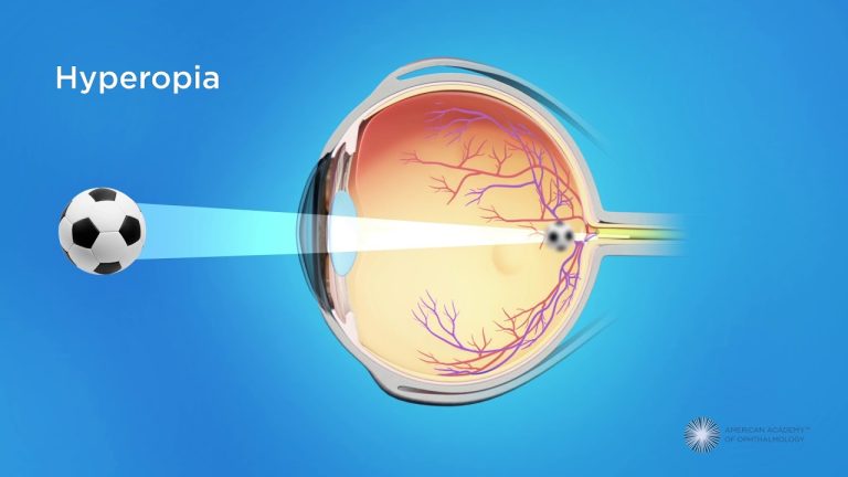 What causes farsightedness?