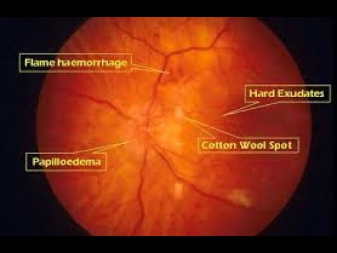 What does hypertensive retinopathy look like?