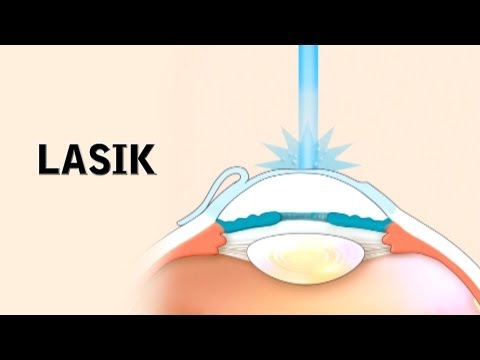 What happens if LASIK fails?