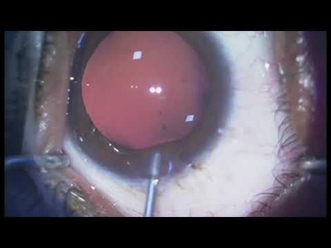 What happens to eyeball in myopia?