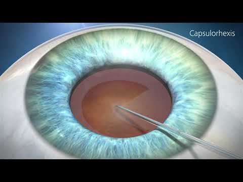 What is an aspheric lens in glasses?