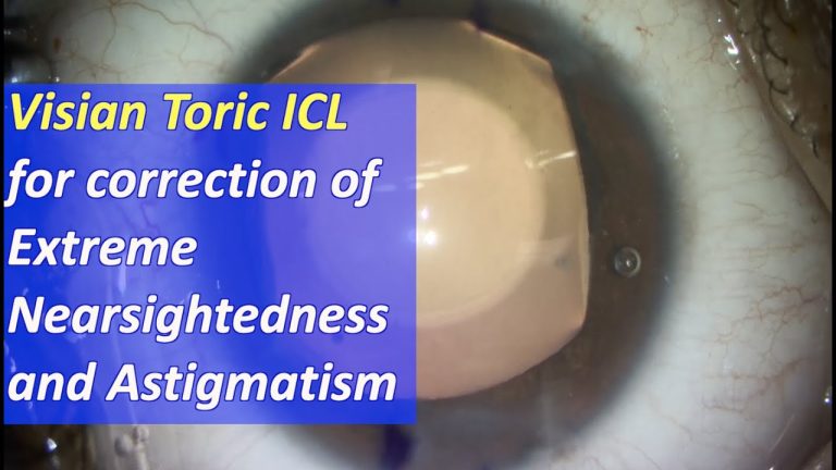 What is astigmatism and myopia?