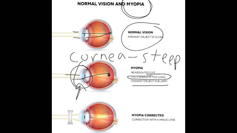 What Is Nearsightedness