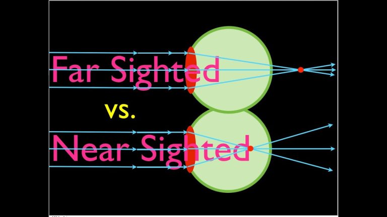 Which lens is used for hyperopia?