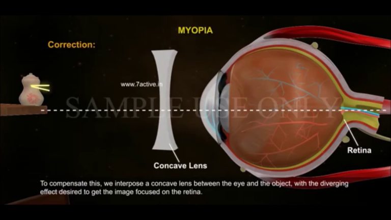 Wikipedia Contact Lenses