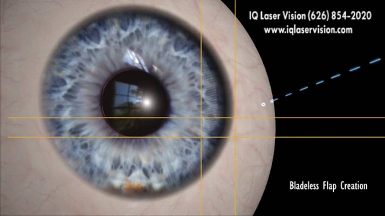 Revolutionizing Optical Surgery with Bladeless Technology: Exploring the Benefits