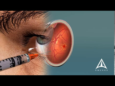 Preventing Macular Degeneration: Expert Advice and Top Products for Optical Health