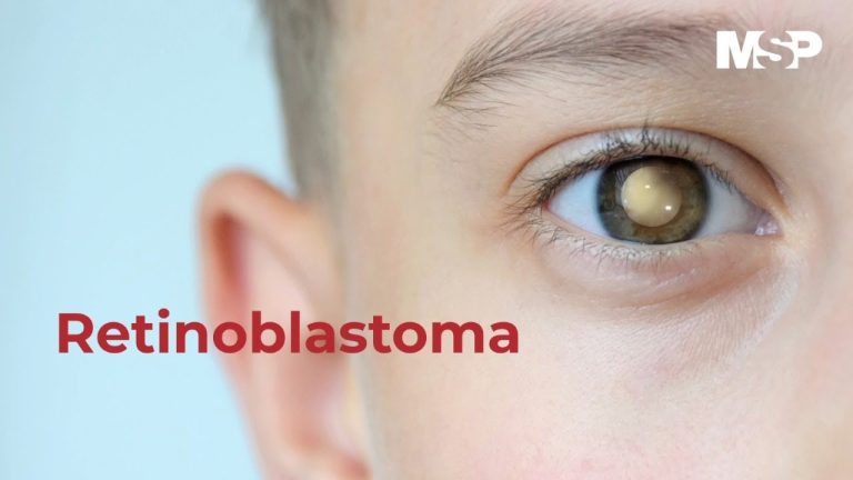 Understanding Retinoblastoma: Symptoms, Diagnosis, and Treatment for Optic Health